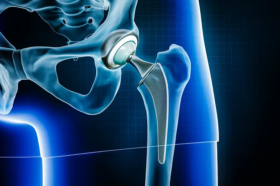 Digital illustration of a human hip joint with a hip replacement implant, showcasing the ball and socket components against a dark blue background with light grids.