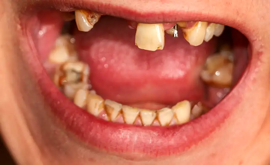 Person with missing tooth and teeth, possibly due to suboxone tooth decay claims.
