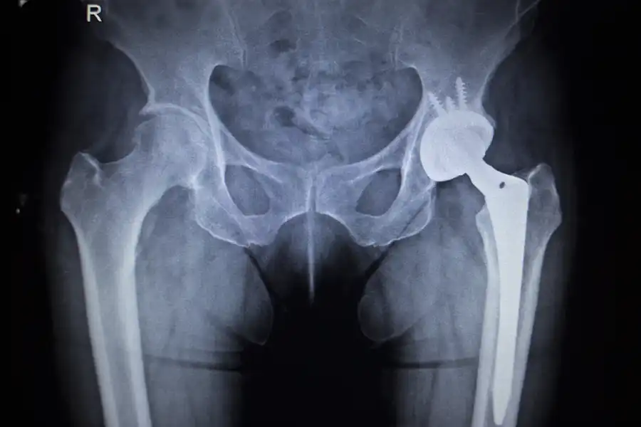 X-ray of hip fracture with bone break in center.