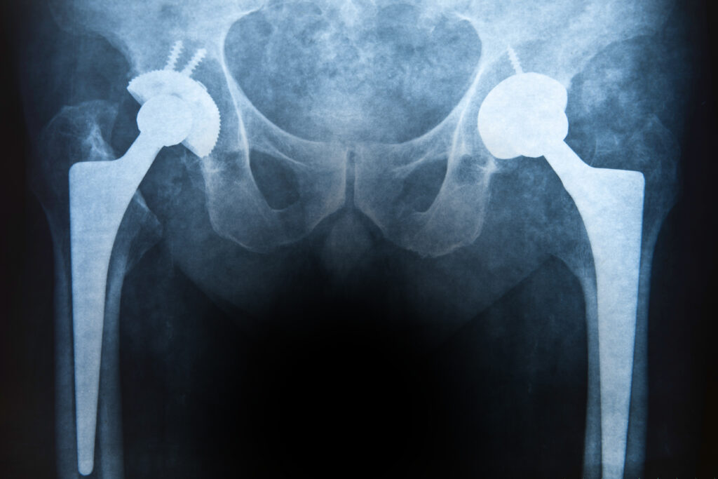 Hip replacement surgery has helped millions of people regain mobility and improve their quality of life. Whether performed because of arthritis, injury, or another medical condition, patients undergo these procedures with the expectation that the implant will reduce pain and provide lasting results. Unfortunately, that is not always the case. Some patients experience serious complications after receiving a hip implant, including device failure, premature wear, loosening of the implant, or metal-related complications. In some situations, these problems may be linked to defects in the medical device itself rather than the patient's underlying condition.
