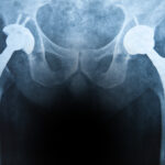 Understanding Your Rights After a Defective Hip Implant Injury